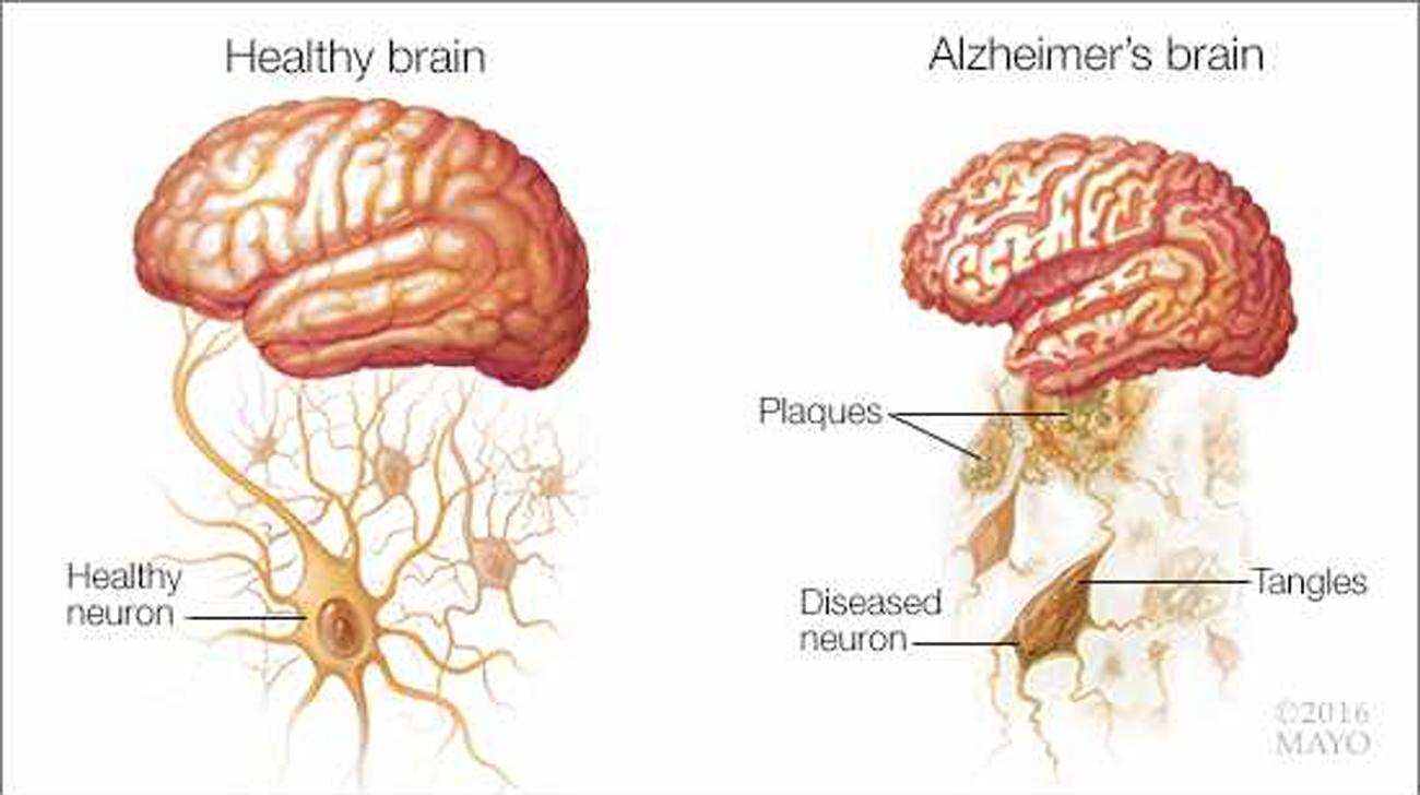 alzheimers_brain_mayo_clinic_0.jpg