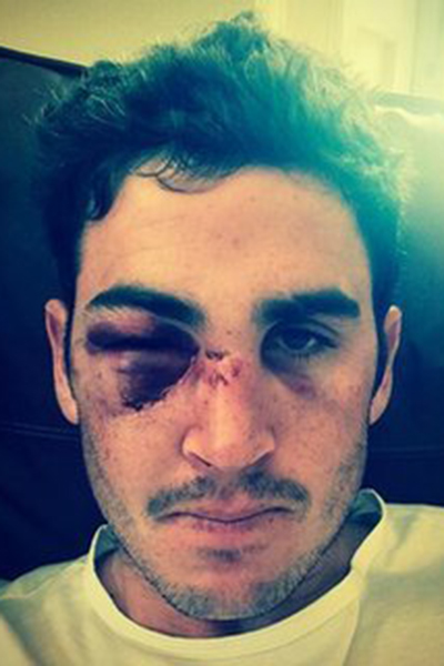 Eye-injury-forces-pic-two-NS.jpg