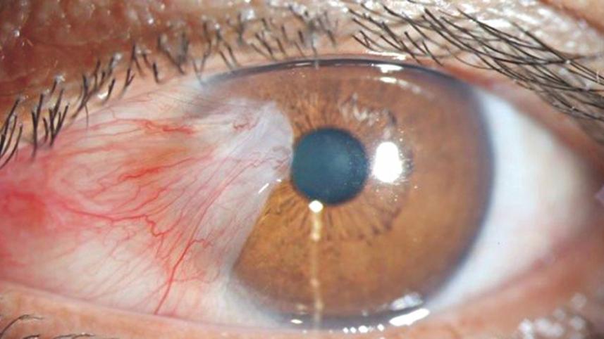eye cancer.jpg
