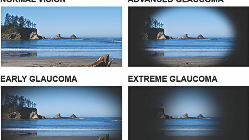 Glaucoma 