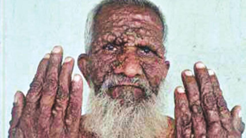 incurable disease Nilphamari.jpg