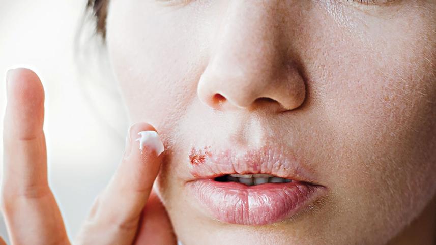 living-with-herpes.jpg