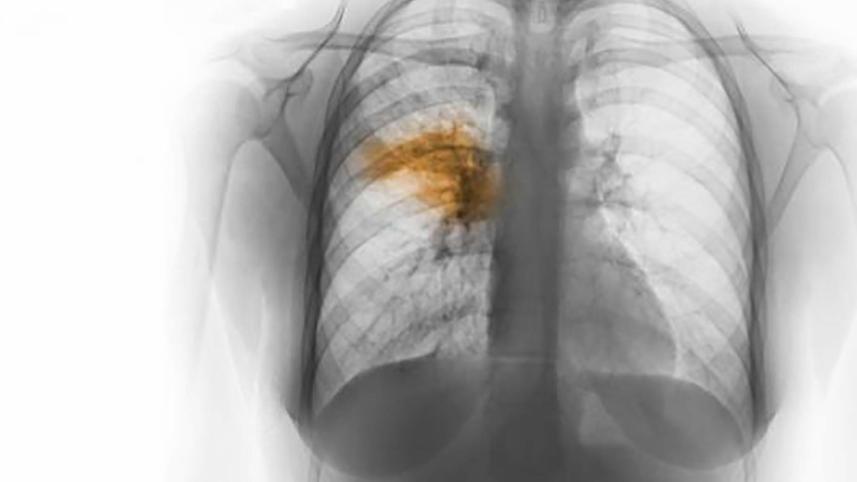 pneumonia_0.jpg