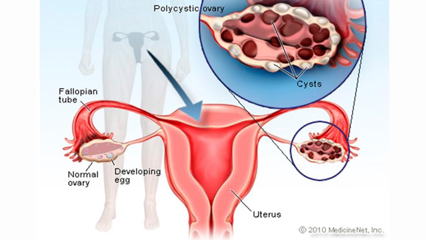 pcos_web.jpg