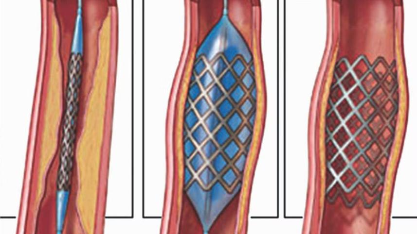 stenting.jpg