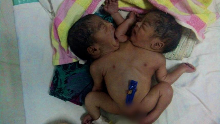 conjoined-twins-smollah2-edt-wb-2.jpg