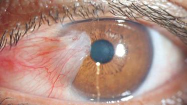 eye cancer.jpg
