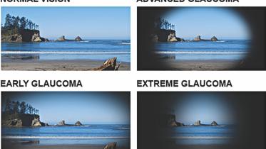 Glaucoma 