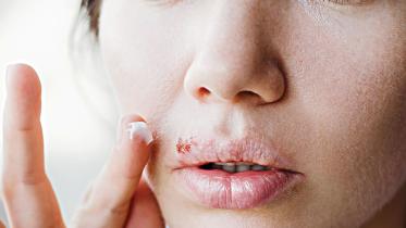 living-with-herpes.jpg