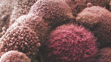 Pancreatic cancer.jpg