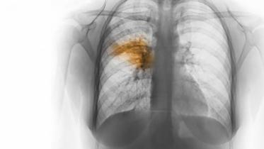 pneumonia_0.jpg
