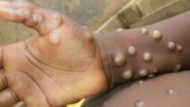 monkeypox-outbreak.jpg