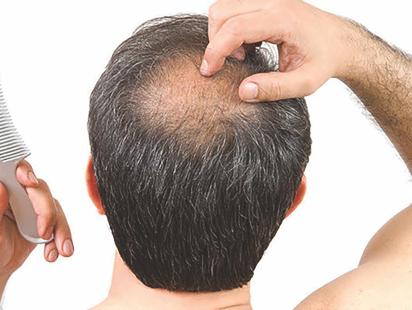men hair loss