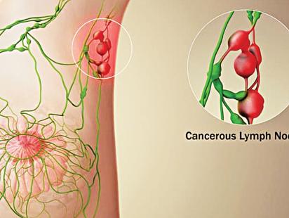 breast-cancer-treatment.jpg