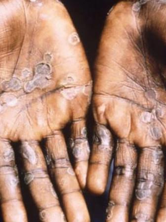 monkeypox-web.jpg
